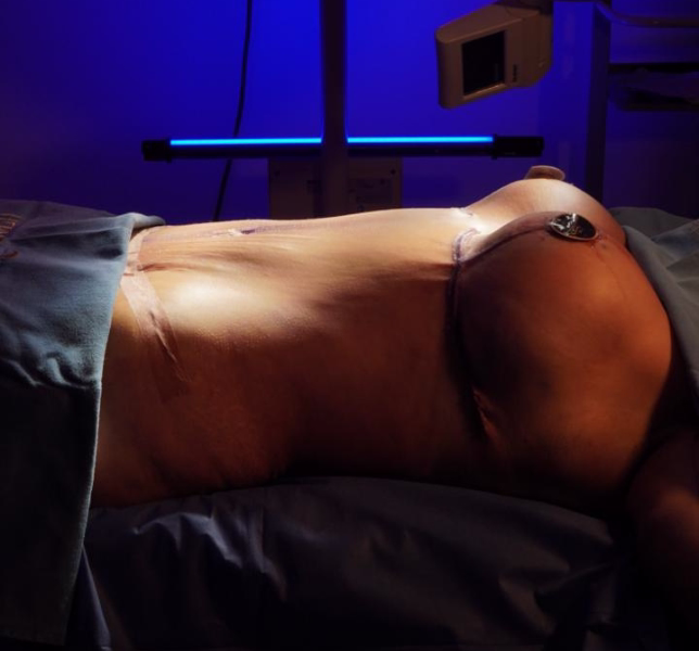 Marcación quirúrgica preoperatoria de abdominoplastia en quirófano - Dr. Hermes Gamba Bogotá