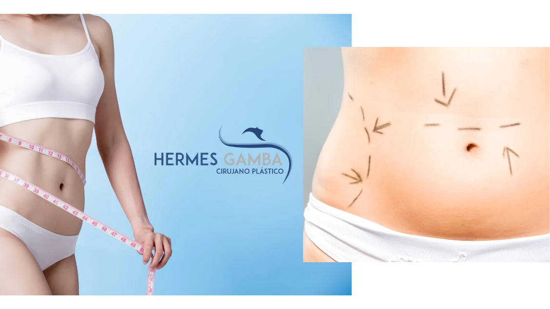 Abdominoplastias realizadas por Hermes Gamba