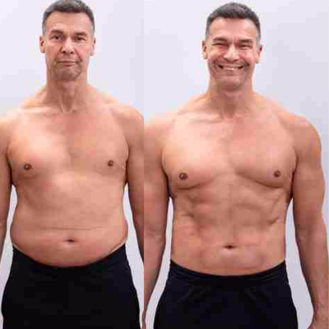 Abdominoplastia masculina Bogotá - Antes y después