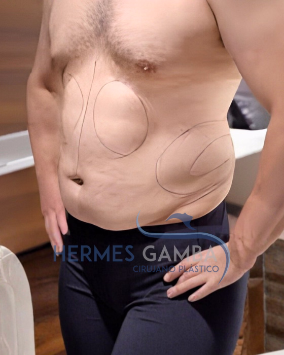 Resultados de abdominoplastia masculina en Bogotá