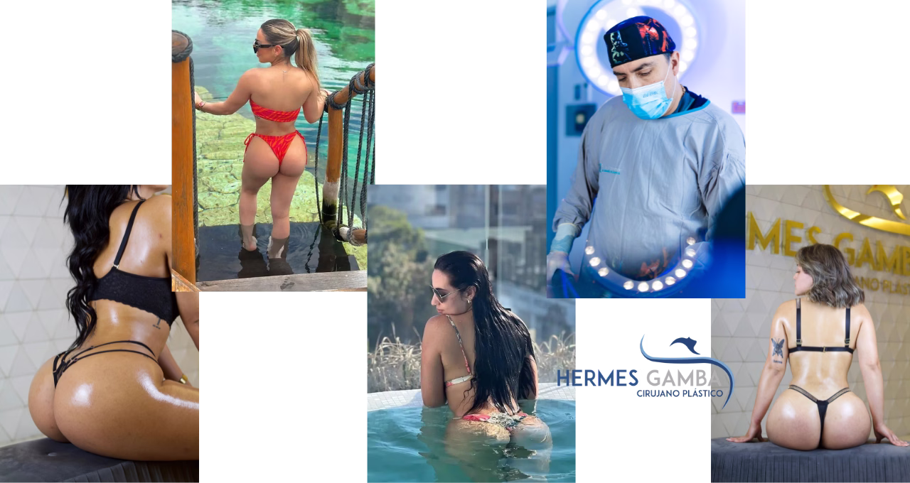Casos de aumento de glúteos con el cirujano Hermes Gamba en Bogotá