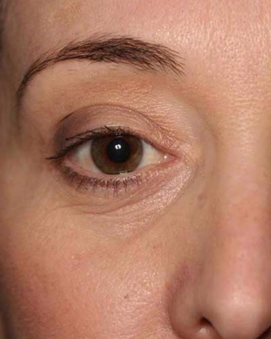 Foto de una blefaroplastia en Bogotá realizada por el cirujano Hermes Gamba