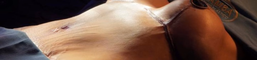 Piel sobrante en el abdomen después de una pérdida de peso significativa, candidata a abdominoplastia — Dr. Hermes Gamba
