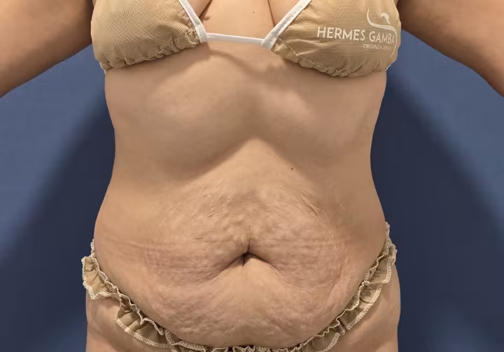 Mujer cuyo abdomen está gordo y no logra la marcación abdominal que desea, pero que está lista para operarse con el doctor Hermes Gamba en Bogotá