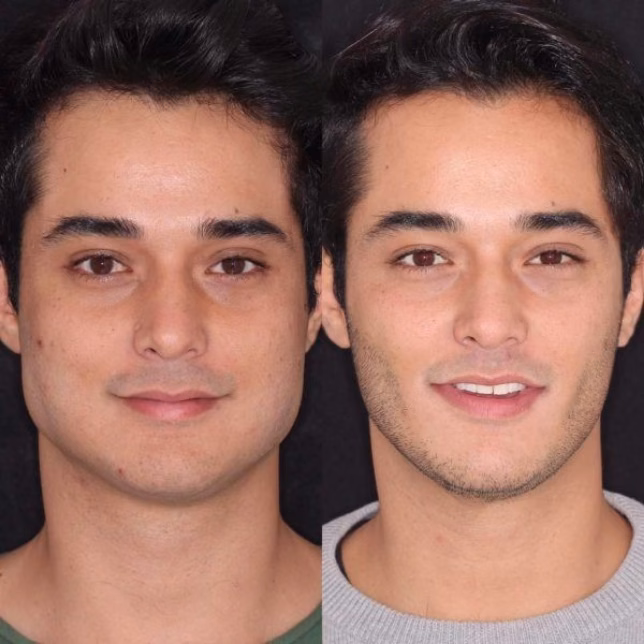 Bichectomía: resultado permanente frente al efecto temporal del contouring facial — Dr. Hermes Gamba