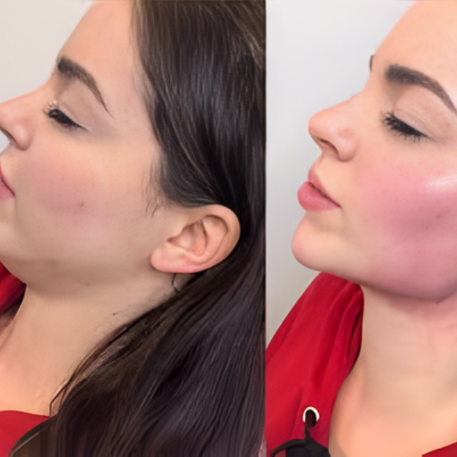 Comparación entre contouring facial temporal y bichectomía como resultado permanente