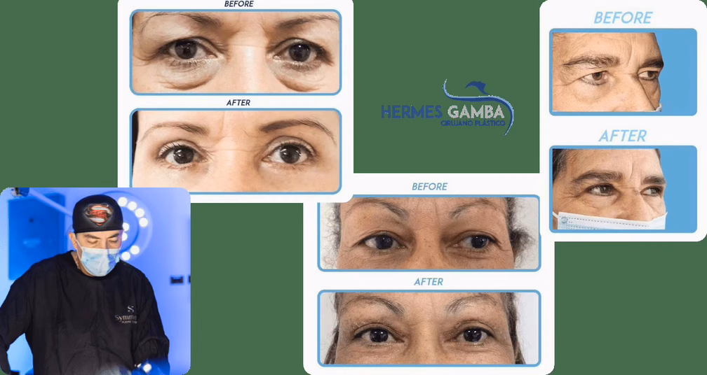 Blefaroplastia Bogotá — qué incluye el precio Dr. Hermes Gamba cirugía de párpados