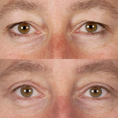 Blefaroplastia tipos superior inferior 4 párpados — Dr. Hermes Gamba Colombia