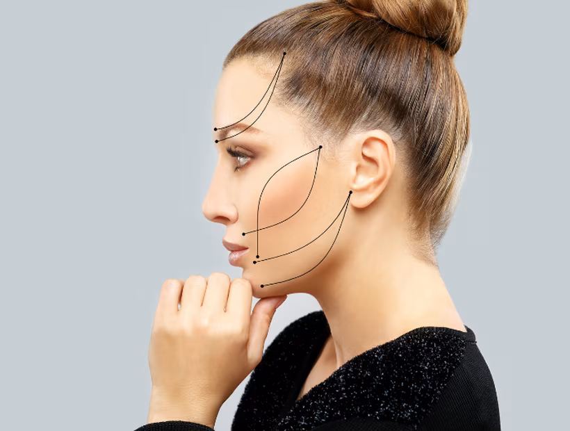 Marcación de perfil facial con líneas de tensión — evaluación para botox o lifting facial