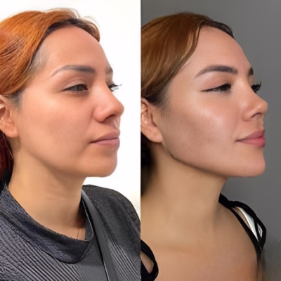 Zonas más comunes de aplicación de botox: entrecejo, frente y patas de gallo — Dr. Hermes Gamba Colombia