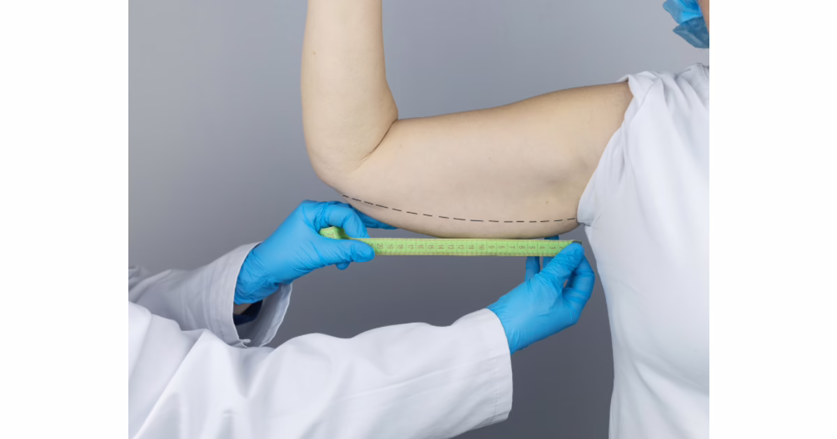 Planificación de la cicatriz de braquioplastia en la axila — Dr. Hermes Gamba Colombia