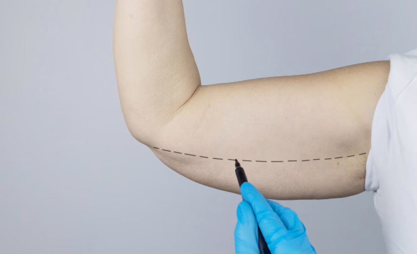Evaluación de piel flácida del brazo — candidato a braquioplastia Examen de piel flácida del brazo antes de braquioplastia — Dr. Hermes Gamba