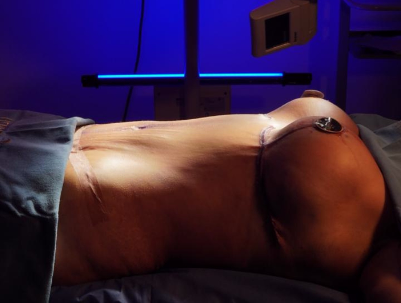 Incisión submamaria en mamoplastia - cicatriz oculta en pliegue mamario