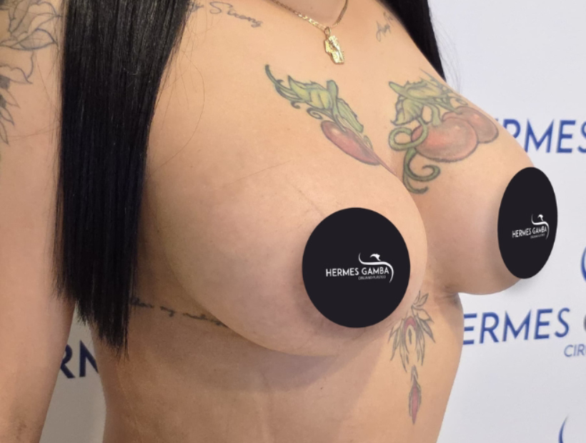 Mamoplastia definicion cirugia mama significado medico