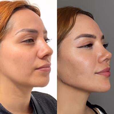 Resultado otoplastia: más que estética, confianza — Dr. Hermes Gamba Colombia Otoplastia cirugía de orejas prominentes resultado y confianza Colombia — Dr. Hermes Gamba