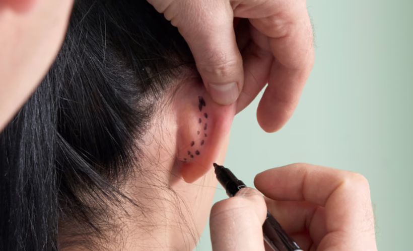 Marcación en el pliegue posterior de la oreja antes de otoplastia — Dr. Hermes Gamba