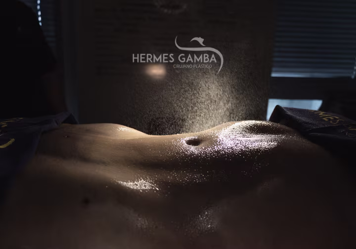 Resultados de un procedimiento Mommy Makeover en Bogotá