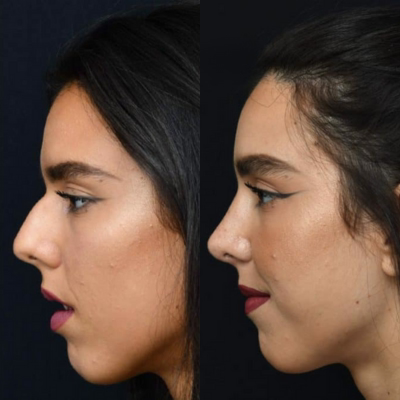 Corrección de giba nasal: diferencia entre disimular con relleno y eliminar con rinoplastia — Dr. Hermes Gamba