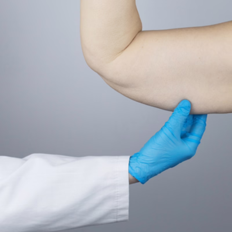 Examen de piel flácida del brazo antes de braquioplastia - Dr. Hermes Gamba
