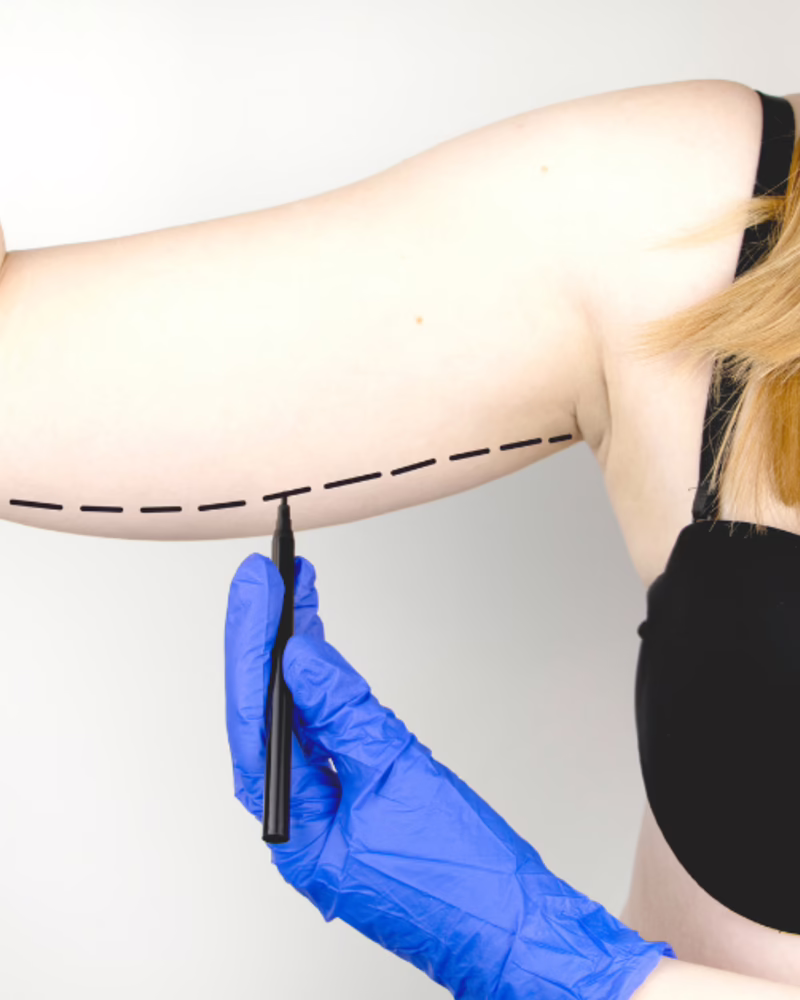 Marcación preoperatoria de braquioplastia en el brazo - Dr. Hermes Gamba