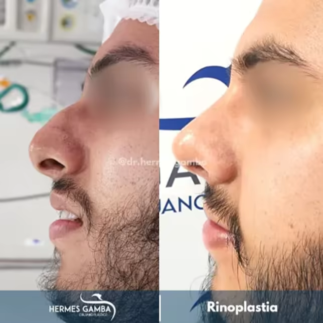 Caso real de candidata a rinoplastia en Tunja Boyacá - Dr. Hermes Gamba