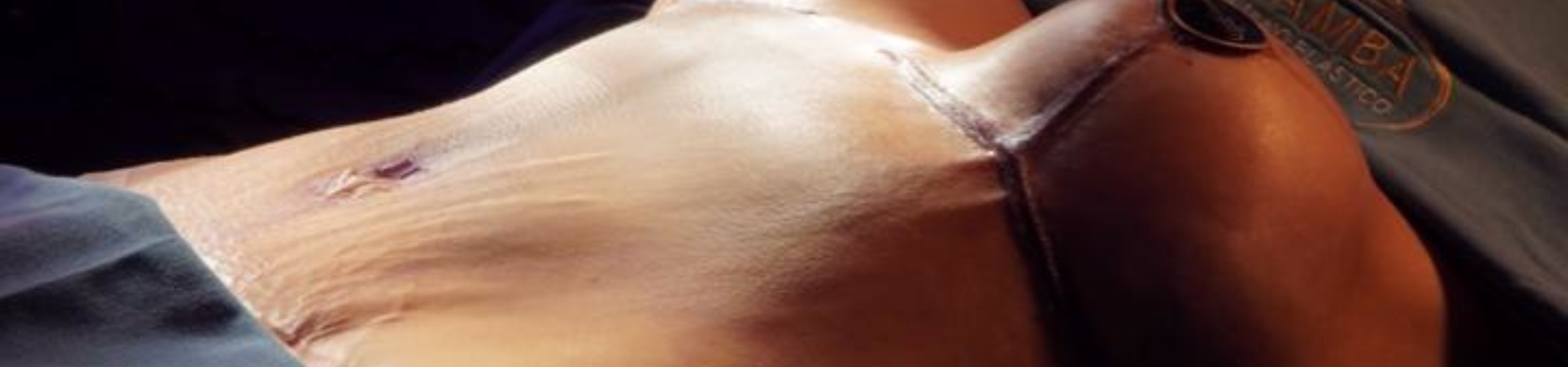 Evolución real de cicatriz de abdominoplastia