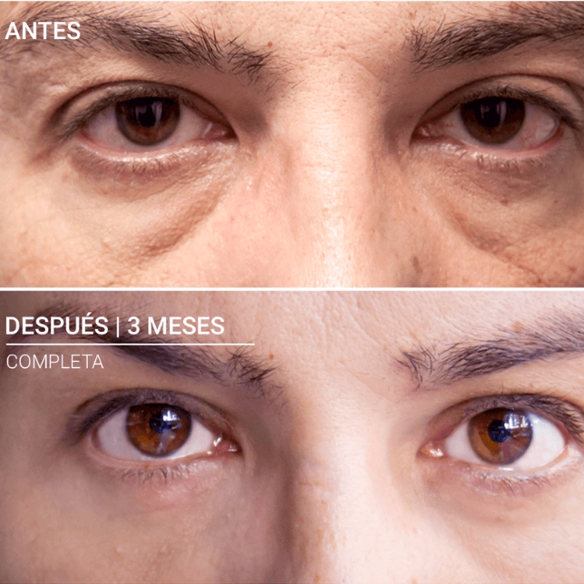 Cirugía párpados superior e inferior blefaroplastia - Dr. Hermes Gamba rejuvenecimiento ocular