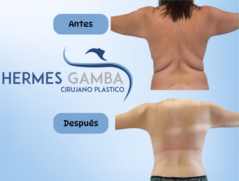 Recuperación lipoescultura brazos y espalda