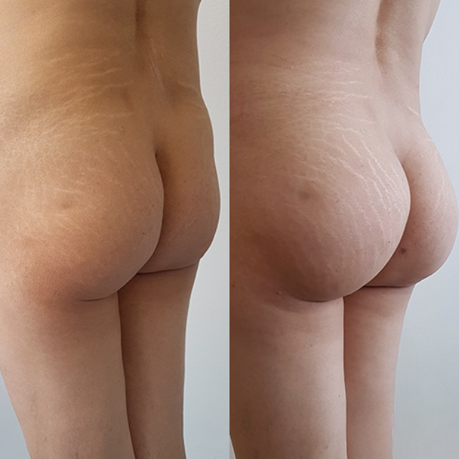 Gluteoplastia masculina en Bogotá con Dr. Hermes Gamba - Resultados naturales y masculinos