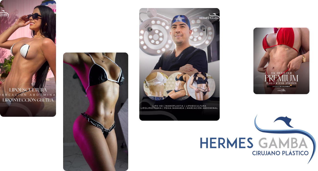 Casos de lipoescultura en Cali, Medellín y Barranquilla con el cirujano Hermes Gamba