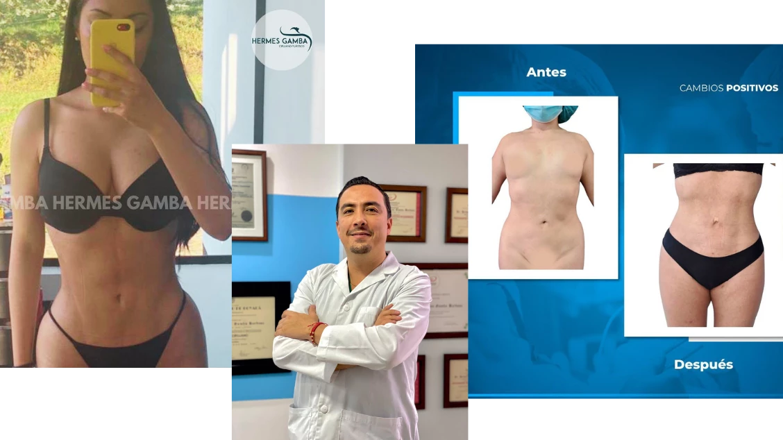 Lipoescultura antes y después Bogotá