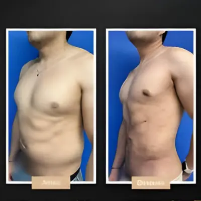 Antes y después de liposucción masculina en abdomen y flancos con definición natural