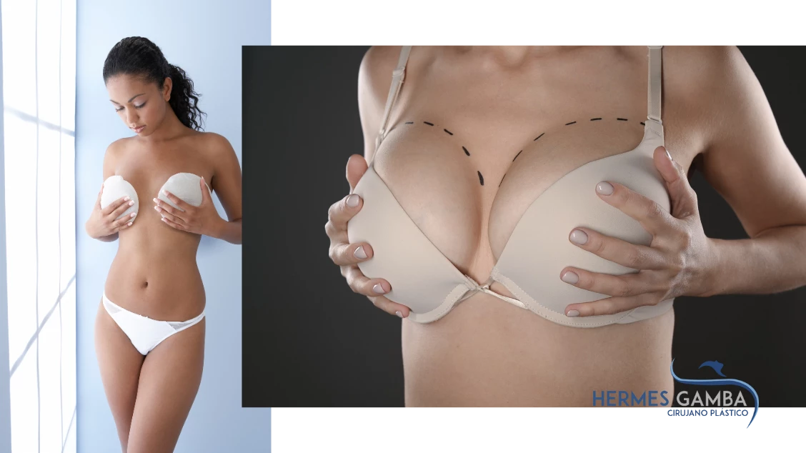 Mamoplastias realizadas en Colombia por Hermes Gamba