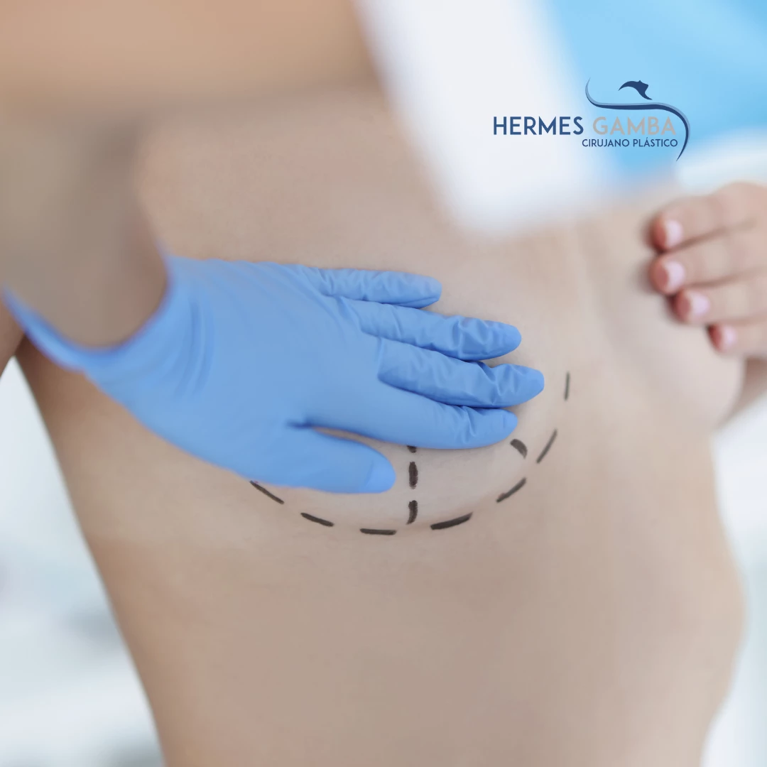 Mamoplastia Premium en Colombia