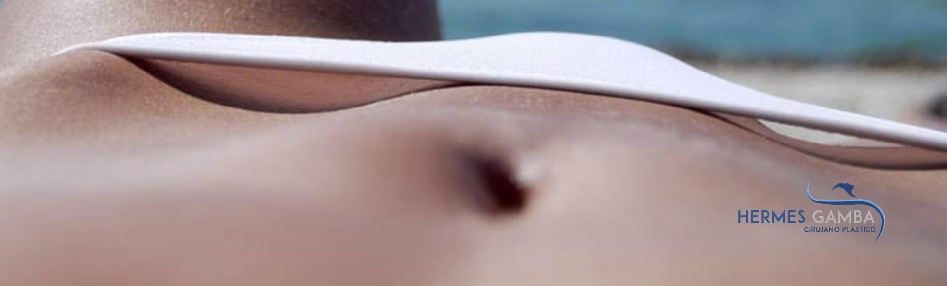 Marcación abdominal técnica VASER HD explicación completa