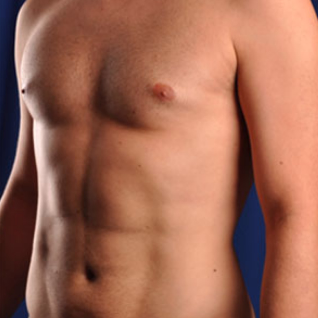 Marcación abdominal hombres liposucción masculina - Dr. Hermes Gamba elimina grasa rebelde