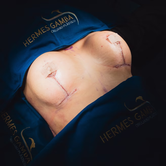 Mastopexia T invertida patrón de Wise - Resultados excelentes Dr. Hermes Gamba