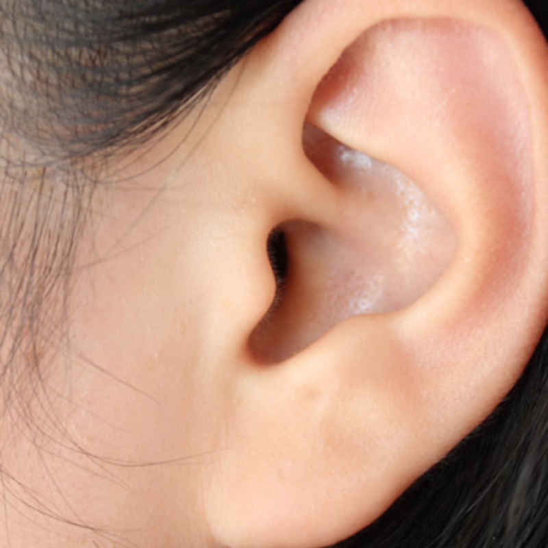 Anatomía de la oreja antes de otoplastia - Dr. Hermes Gamba
