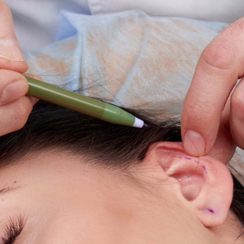 Marcación quirúrgica del pliegue posterior antes de otoplastia - Dr. Hermes Gamba