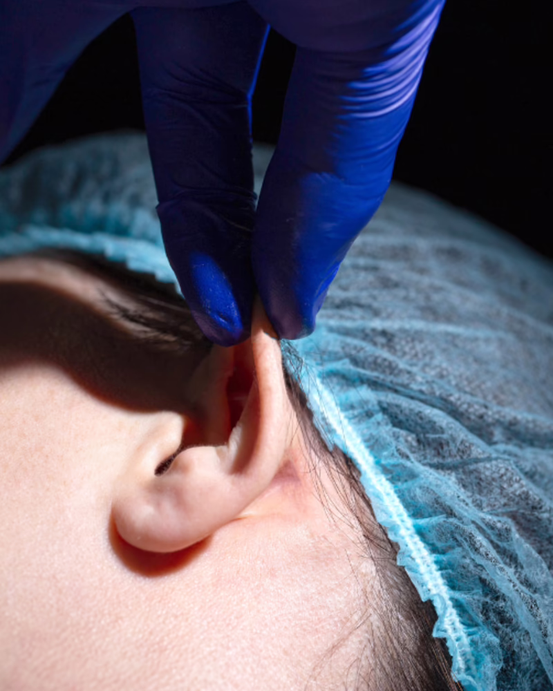 Marcación preoperatoria de otoplastia en consulta con el Dr. Hermes Gamba en Bogotá
