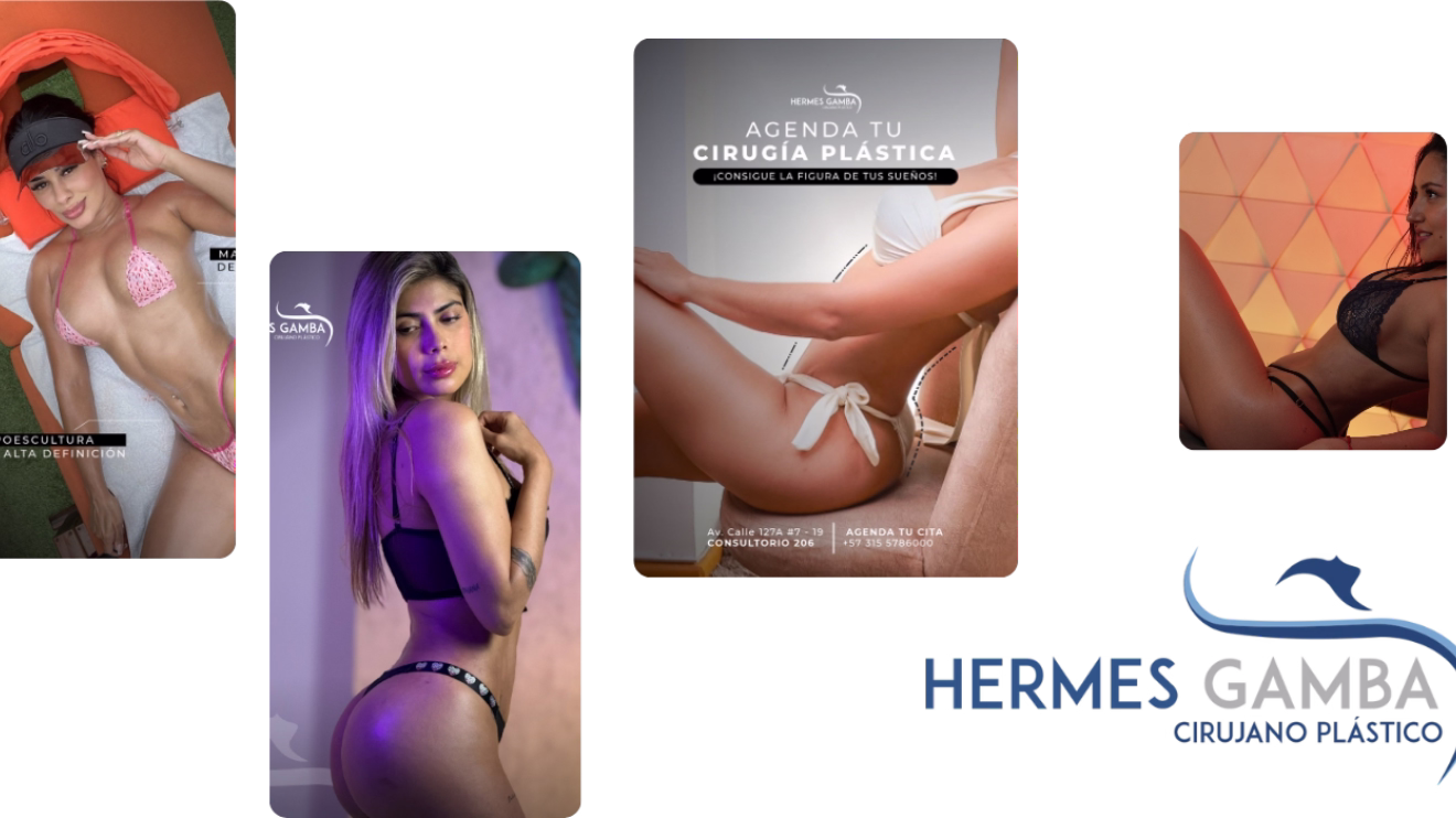 Proceso de lipoescultura VASER paso a paso - Dr. Hermes Gamba