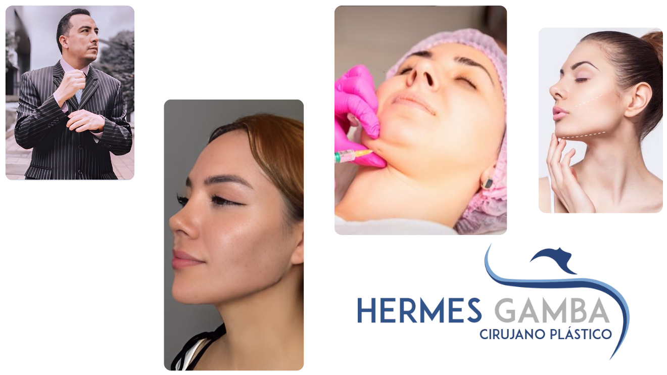 Proceso de liposucción de papada paso a paso - Dr. Hermes Gamba