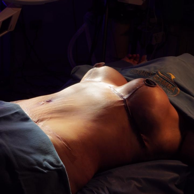 Recuperación abdominoplastia primeros 15 días - Cronograma día a día Dr. Hermes Gamba