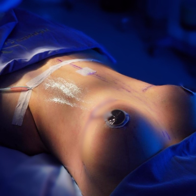 Resultado abdominoplastia en Tunja Boyacá - Clínica Green Hills Dr. Hermes Gamba cirujano plástico