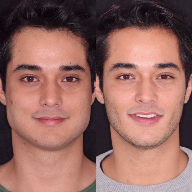 Resultado bichectomía en Bucaramanga Santander - definición facial Clínica Ardila Lülle Dr. Hermes Gamba