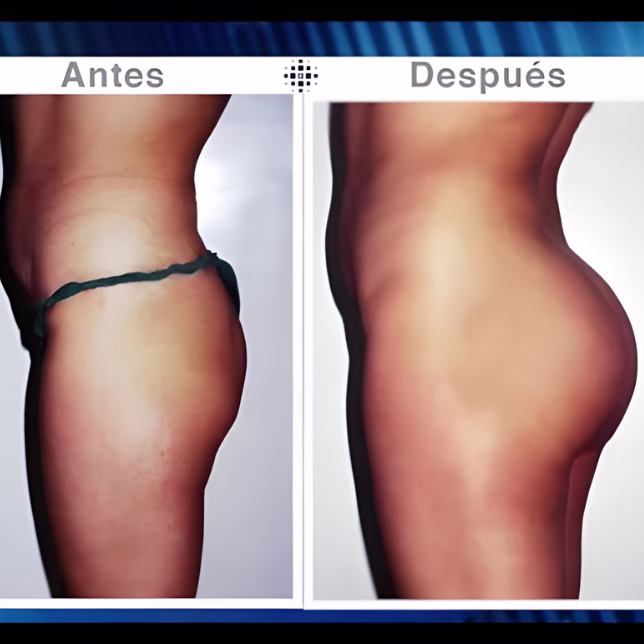 Resultado gluteoplastia en Bucaramanga Santander - aumento de glúteos Clínica Ardila Lülle Dr. Hermes Gamba