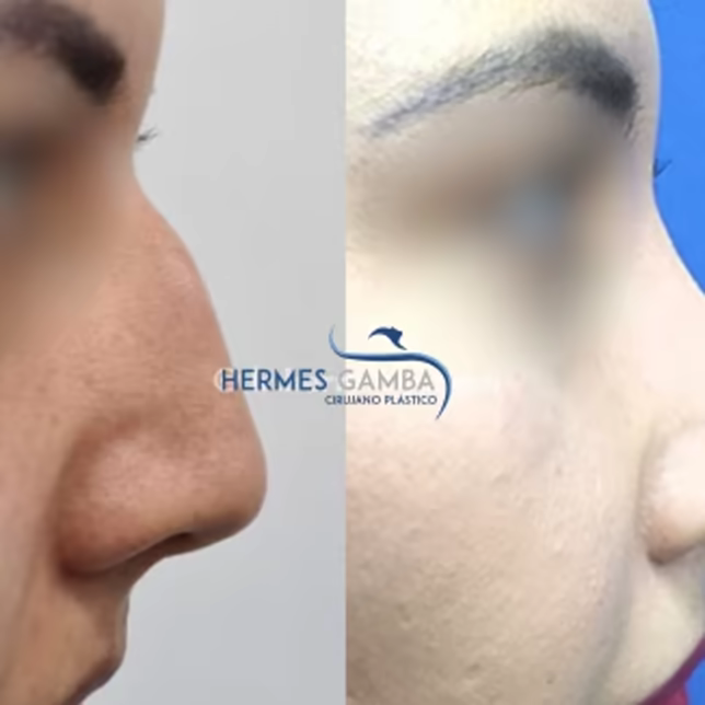 Resultado real rinoplastia en Bogotá - cirugía de nariz natural antes y después Dr. Hermes Gamba Usaquén