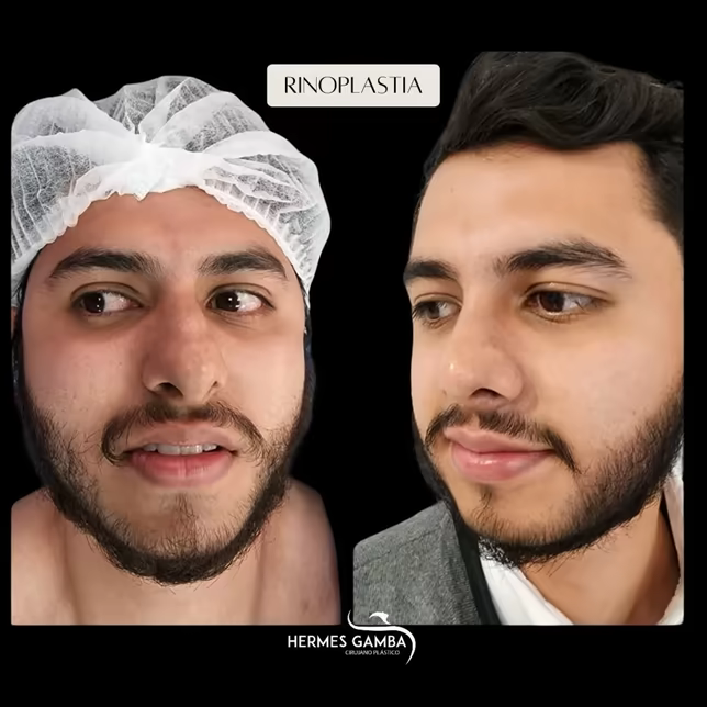Resultado real rinoplastia en Bucaramanga Santander - cirugía de nariz Dr. Hermes Gamba Clínica Ardila Lülle