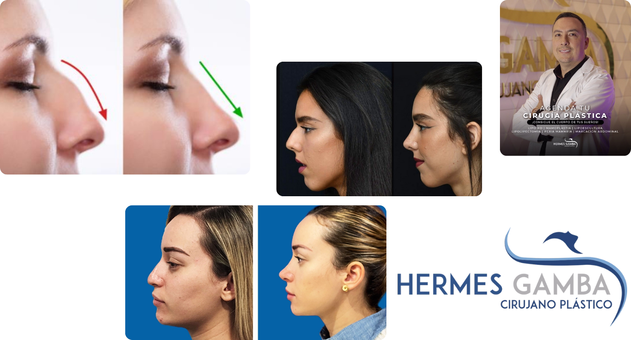 Rinoplastia ultrasónica de precisión Procedimiento de rinoplastia con tecnología piezoeléctrica