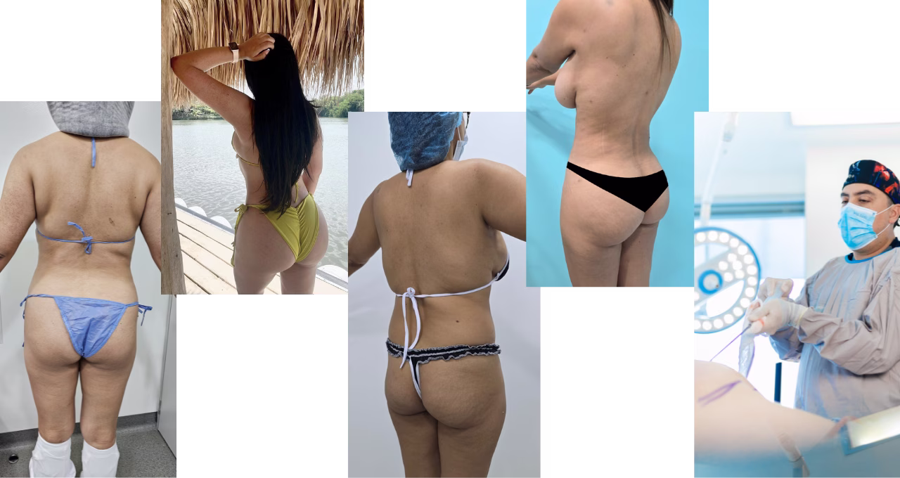 Técnicas cubanas de gluteoplastia en Bogotá